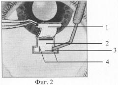 Способ хирургического лечения открытоугольной глаукомы (патент 2308917)