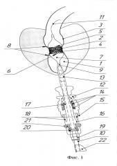 Метод и устройство для имплантации баллонорасширяемого протеза клапана сердца (патент 2625285)