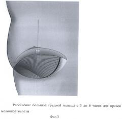 Способ формирования кармана для имплантата в двойственной плоскости при аугментационной маммопластике (патент 2501528)