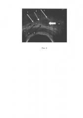 Способ диагностики лейомиомы мочевого пузыря (патент 2611896)