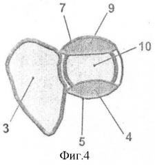 Способ закрытого вправления пронационного подвывиха головки лучевой кости у детей (патент 2405492)