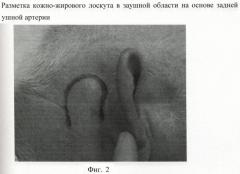 Способ пластики центрального сквозного дефекта ушной раковины (патент 2400198)