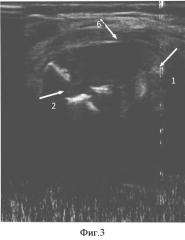 Способ ультразвуковой диагностики острого гематогенного метаэпифизарного остеомиелита у детей грудного возраста (патент 2503413)