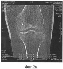 Способ определения степени изменения губчатой кости при деформирующем артрозе коленного сустава (патент 2487669)