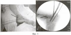 Способ лечения переломов пяточной кости (патент 2440046)