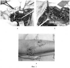 Способ посттравматической реконструкции поврежденного периферического нерва (патент 2515761)