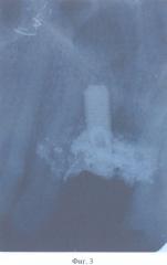 Зубной протез с опорой на внутрикостные имплантаты (патент 2326621)