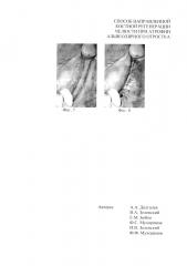 Способ направленной костной регенерации челюсти при атрофии альвеолярного отростка (патент 2648861)