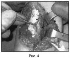Способ восстановления активного сгибания в локтевом суставе у больных с артрогрипозом (патент 2434596)