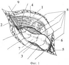 Способ обработки грыжевого мешка при косых паховых грыжах (патент 2314048)