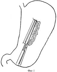 Способ иссечения больших фрагментов передней стенки желудка (патент 2395236)