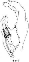 Способ двухэтапной пересадки пальца стопы на кисть (патент 2345726)