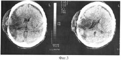 Способ лечения черепно-мозговой травмы (патент 2366466)