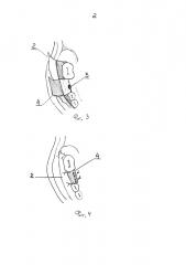 Способ формирования слизисто-надкостничного лоскута при пластике оро-антрального соустья (патент 2599683)