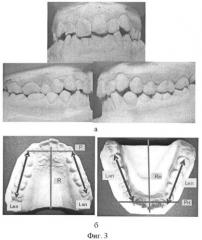 Способ биометрической диагностики направления и величины перемещения зубов при ортодонтическом лечении (патент 2436538)