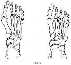 Способ оперативного лечения деформации переднего отдела стопы (патент 2428127)