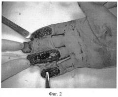 Способ васкуляризированной кожной пластики дистальных отделов пальцев кисти островковым осевым лоскутом на временной питающей ножке (патент 2544100)