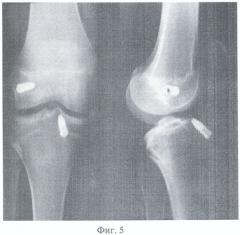 Способ пластики передней крестообразной связки коленного сустава у детей (патент 2432125)