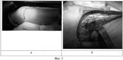 Хирургический доступ к наружному мыщелку большеберцовой кости для остеосинтеза при переломах (патент 2525211)
