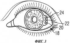 Устройство для фиксации элемента к глазу (патент 2463028)