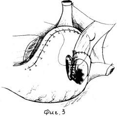 Способ формирования арефлюксного эзофаго-гастроанастомоза при лечении рака желудка (патент 2346661)