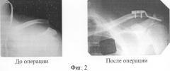 Способ остеосинтеза акромиально-ключичного сустава (патент 2296523)