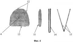 Способ создания резервуарно-клапанной тонкокишечной стомы (патент 2375973)