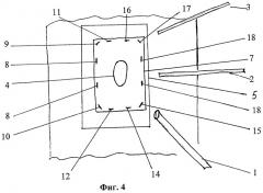 Способ лапароскопической герниопластики вентральных грыж (патент 2453277)