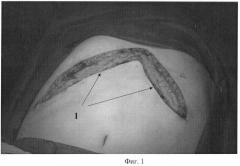 Способ профилактики кишечных свищей при этапном лечении панкреонекроза (патент 2463003)