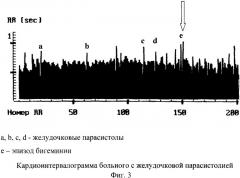 Способ диагностики нарушений ритма и проводимости сердца у детей посредством пробы с компрессией области желчного пузыря (патент 2328211)