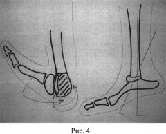 Способ устранения пяточной деформации однолучевой стопы при продольной эктромелии костей голени (патент 2539628)