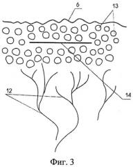 Способ микроинвазивной трансвитреальной шовной фиксации краев ретинального дефекта (патент 2535783)