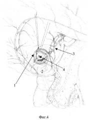 Способ хирургического лечения лейомиом задней стенки антрального отдела желудка (патент 2253376)