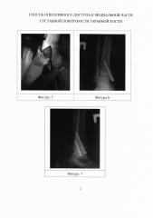 Способ оперативного доступа к медиальной части суставной поверхности таранной кости (патент 2638280)