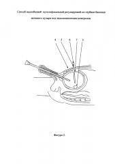 Способ надлобковой мультифокальной регулируемой по глубине биопсии мочевого пузыря под эндоскопическим контролем (патент 2641838)