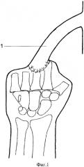 Способ реконструкции кисти при ампутационных культях всех пальцев (патент 2572551)