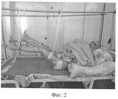 Способ лечения пролежней у больных с ортопедической патологией в ходе ее устранения с применением аппаратов внешней фиксации (патент 2515756)