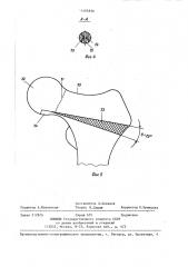 Устройство р.в.никогосяна и б.н.балашева для остеосинтеза бедренной кости (патент 1405830)