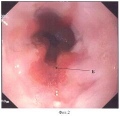 Способ эндоскопического лечения пищевода барретта (патент 2405495)