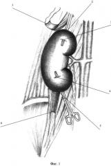 Способ лечения пациентов с нефроптозом, сочетающимся с ротацией почки (патент 2528642)