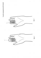 Способ удлинения культей пальцев (патент 2594256)