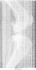 Биоимплантат для возмещения дефектов минерализованных тканей и способ его получения (патент 2311167)