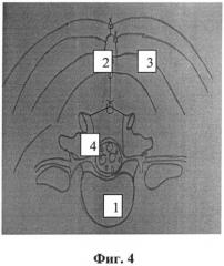 Способ реконструкции позвоночного канала при лечении стеноза пояснично-крестцового отдела позвоночника (патент 2531927)
