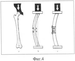 Способ остеосинтеза переломов шейки бедра и устройство для его осуществления (патент 2525739)