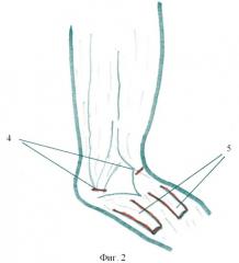 Способ лечения врожденной сгибательной контрактуры коленного сустава у детей при гипо- и аплазии сгибателей голени (патент 2423086)