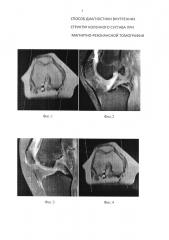 Способ диагностики внутренних структур коленного сустава при магнитно-резонансной томографии (патент 2656562)