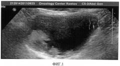 Способ ультразвукового исследования мочевого пузыря у онкоурологических больных (патент 2494678)