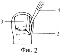 Способ лечения вросшего ногтя с использованием аппарата 