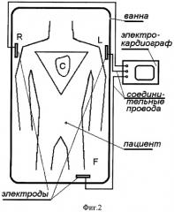 Способ регистрации электрокардиосигнала пациента, находящегося в электропроводной жидкости (патент 2316250)