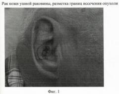 Способ пластики центрального сквозного дефекта ушной раковины (патент 2400198)